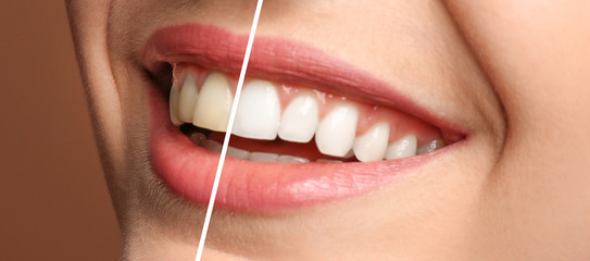 Smiling woman before and after teeth whitening procedure, closeup