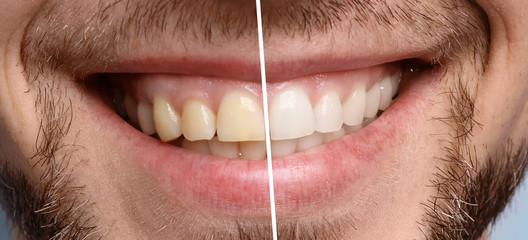 Smiling man before and after teeth whitening procedure, closeup