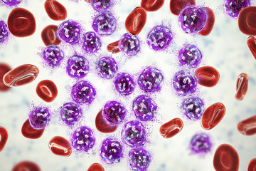 Destruction of lymphoblasts. Conceptual 3D illustration of treatment of acute lymphoblastic leukemia