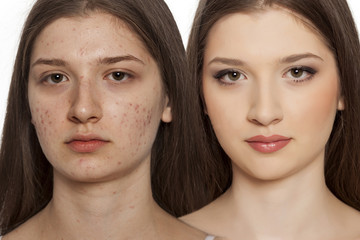 comarision portratit of teenage girl with problematic skin, before and after skin traitment on...
