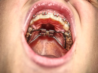 Teen with braces on his teeth. Macro shot of teeth with braces.