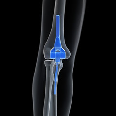 3d rendered medically accurate illustration of an elbow replacement