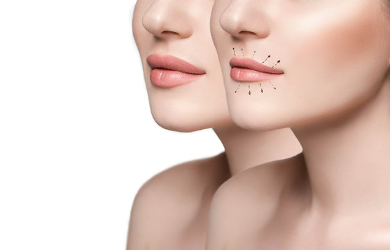 compare woman lips before and after lip augmentation