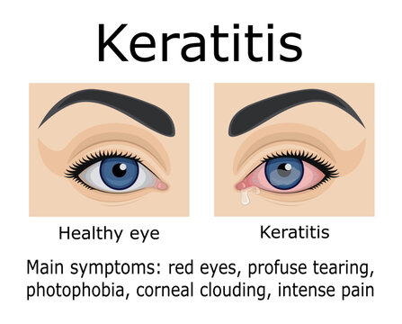 Illustration of Keratitis disease