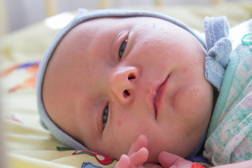 sleepy baby lies,newborn infant with acne on face
