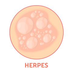 Herpes on the skin. Healthcare and dermatology