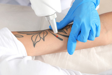 Woman undergoing laser tattoo removal procedure in salon, closeup