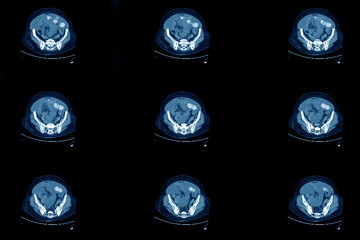 Mri ct scan of human ovaries with cancerous lumps.