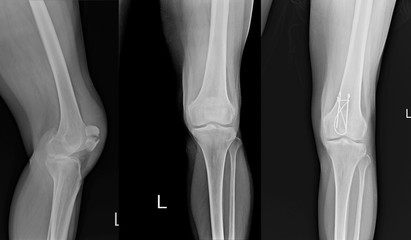 X-ray Left Knee lateral Showing Kneecap fracture and Post operation fixation with K-wire kneecap.