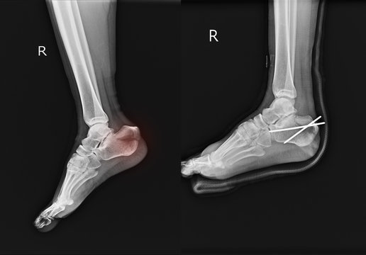X-ray Fracture calcaneus-heel and Post operation fixcation.