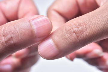 Longitudinal ridging nail. ( vertical nail ridges). The common causes of the ridges are health...