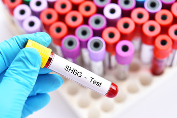 Obraz premium Blood sample tube for sex hormone binding globulin or SHBG test 