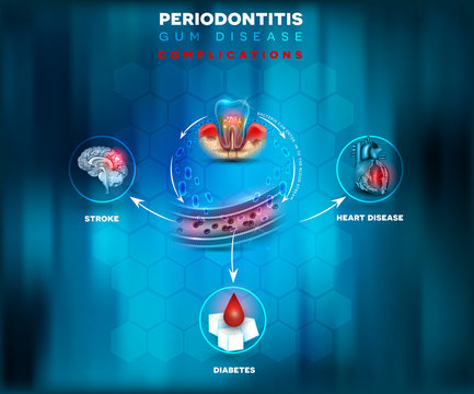 Periodontitis complications, bacteria enter in to the blood flow and there is a risk of stroke, diabetes and heart disease