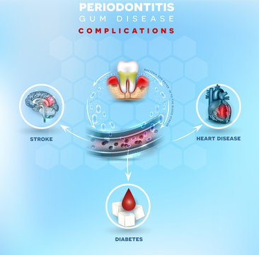 Periodontitis, Inflammation Of The Gums Bacteria Can Enter In To The Blood Stream And Initiate Complications In Other Parts Of Body, Such As Stroke, Diabetes And Heart Disease