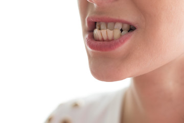 Problem teeth at the young girl. A curve row and the wrong bite an occasion to visit the dentist...