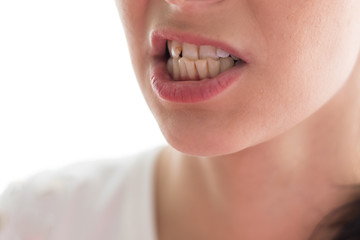 Problem teeth at the young girl. A curve row and the wrong bite an occasion to visit the dentist...