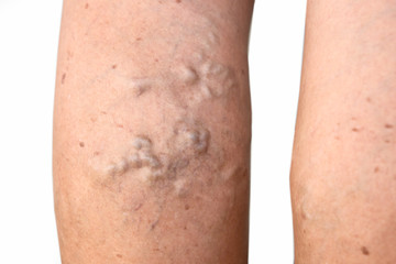 varicose veins on female leg isolated on white background 