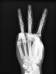 X-ray of the hands