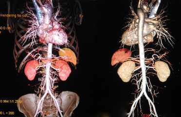 CTA (computed tomography angiographphy)or MRA (Magnetic Resonance Angiography)3D take photo from film x-ray of whole aorta