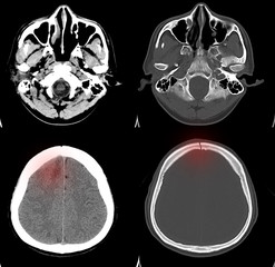 CT-Scan brain a human showing fracture skull with bleeding nematoma.