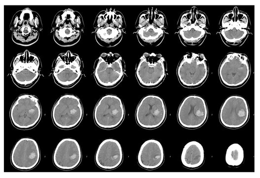 Computed tomography of the brain, hemorrhagic stroke.