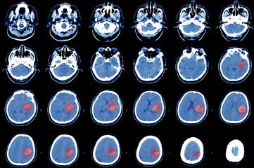 Computed tomography of the brain, hemorrhagic stroke.