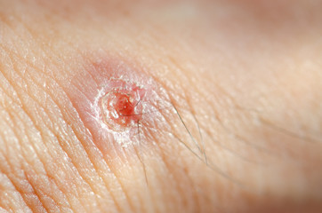 Abscess on man hand,select focus