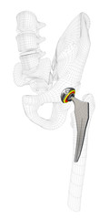 3d Illustration of Hip joint replacement, isolated gray