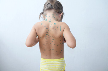 Child back with chickenpox. Sick little girl  with varicells making eruption on skin. Long home...