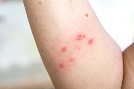 skin infected herpes zoster virus on woman arm closeup 