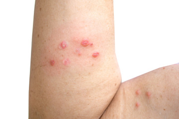 skin infected herpes zoster virus on woman arm closeup 
