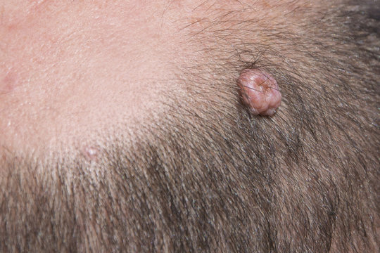 Birthmark of a teratoma on the skin of an man's head close-up