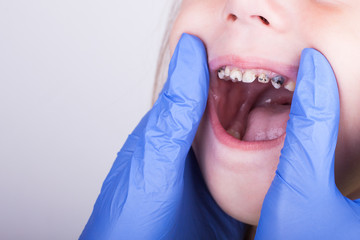 Dental medicine and healthcare - dentist examining little child girl patient open mouth showing...