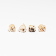 pulled out bad molars human teeth close up on white background