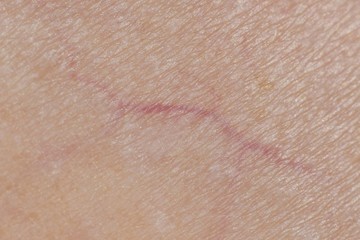 Macro photo of veins on human skin, Microvarices