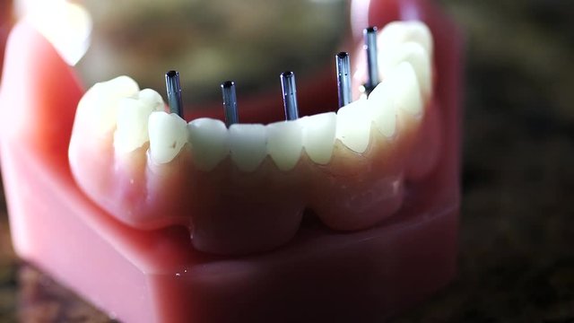 Model teeth lower mouth with implant rods shot with dramatic lighting