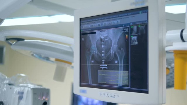 An x-ray shot of patient's hips on a screen in a surgery room. 4K