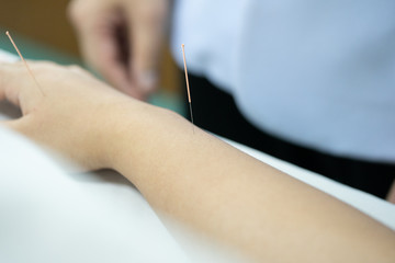 Treatment of Chinese Acupuncture at an arm and hand of a patient.