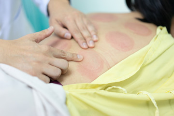 Fototapeta premium Chinese treatment, Glass cure on the back of a patient.