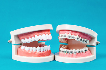 Compare tooth model and tooth model with metal wire dental braces.