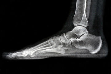 Radiographie du pied 