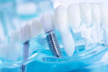 Dentist dental teeth implant - obrazy, fototapety, plakaty
