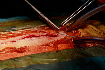 A surgeon is stitching a wound after an operation in a hospital