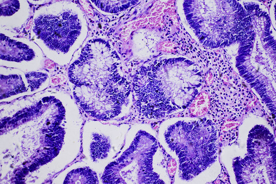 Intestinal adenomatosis