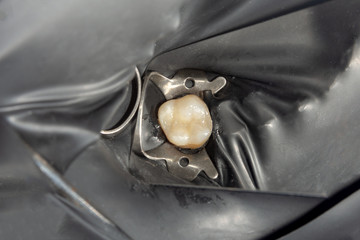 two chewing side teeth of the upper jaw after treatment of caries. Restoration of the chewing...