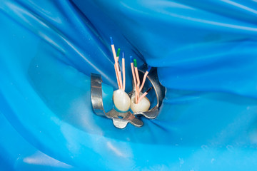 photo endodontic treatment of dental canals in the lower molar permanent tooth molar with endodontic file with apex locator, tooth with clamp attached to it by cofferdam