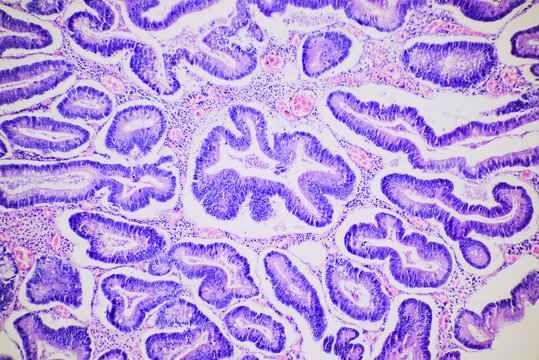 Intestinal adenomatosis