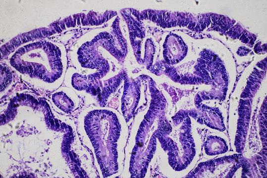 Intestinal adenomatosis