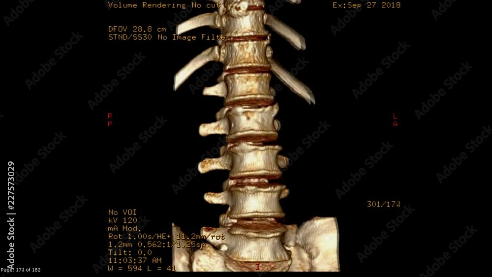 Poster ct scan image 3d rendering of lumbar spine rotating on the screen. medical technology concept.