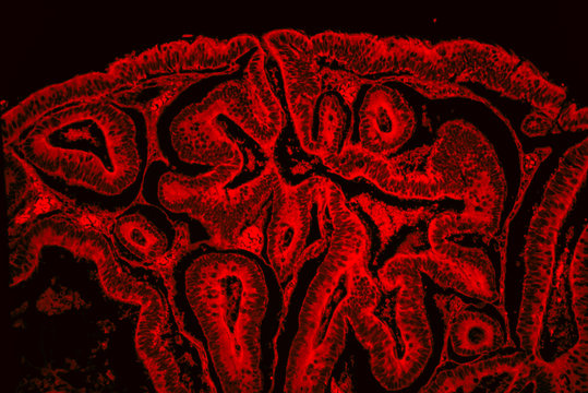 Intestinal adenomatosis